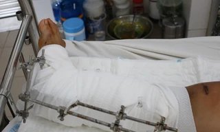 Cứu bé gái 15 tuổi khỏi tàn phế sau khi dập nát chân vì tai nạn