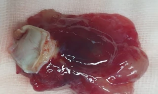 Khối u tim to bằng quả trứng, nữ bệnh nhân may mắn thoát cửa tử thần