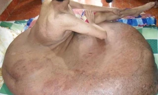 "Chân voi" khổng lồ khiến cuộc sống anh Hải khổ sở trong thời gian dài