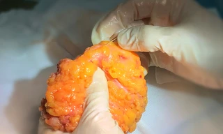 Khối silicon trong ngực được lấy ra sau phẫu thuật