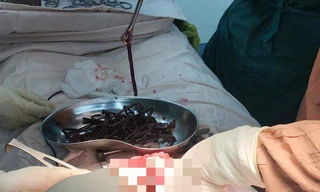 Bác sĩ 'choáng' khi phát hiện vô số đinh, thìa, lưỡi dao trong bụng nam bệnh nhân