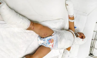 Trẻ nhập viện do phỏng xăng (ảnh: BVCC)