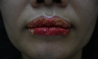 Nhiều phụ nữ bị tai biến làm đẹp khi xăm