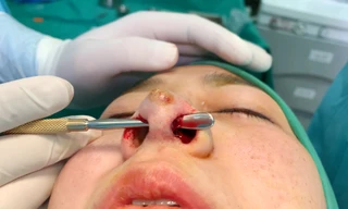 Cận cạnh vách ngăn toang hoắc, xuyên thủng mũi