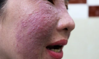 Làn da nổi đỏ từng mảng khi làm đẹp cấp tốc