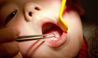 Nhiều trẻ nuốt dị vật do sự bất cẩn của người lớn