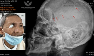 Hàng trăm mảnh đạn li ti nằm trong đầu bệnh nhân 