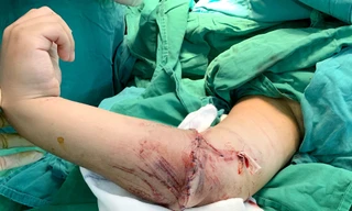 Cánh tay sau khi được Bệnh viện Nhi đồng 2 nối thành công