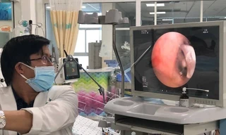 TS.BS Trịnh Hồng Nhiên đang nội soi gắp dị vật cho bệnh nhi (ảnh: BVCC)