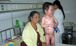 Những vết phỏng nước hiểm nghèo