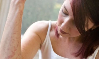 Thuốc vườn nhà chữa bệnh 'giời leo'