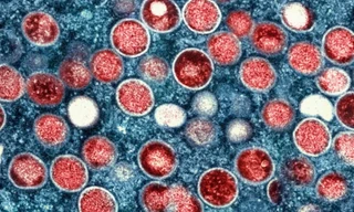 Một chủng mới của bệnh đậu mùa khỉ đang lây lan nhanh ở châu Phi