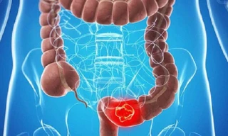 Phát hiện dấu hiệu sớm ung thư đại tràng
