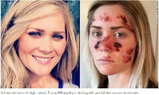 Cô gái bị ung thư da do nghiện nhuộm da nâu