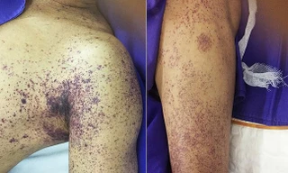 Lại có người tử vong vì ăn tiết canh