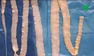 Bị nhiễm sán lợn có chữa khỏi hoàn toàn được không?