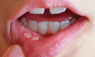 Ung thư ngỡ chỉ là nhiệt miệng, người đàn ông phải cắt cả góc má