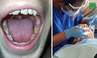 Nghiện nước tăng lực, chàng trai bị mục nát hàm răng