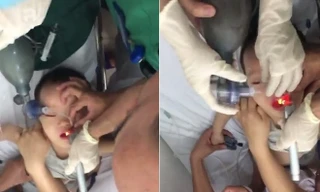 Căng não bác sĩ cứu bé trai ngưng tim ngưng thở vì hóc thạch rau câu