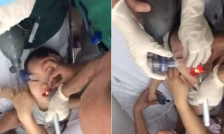 Căng não bác sĩ cứu bé trai ngưng tim ngưng thở vì hóc thạch rau câu