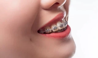 Tại sao bạn chấp nhận chi hàng chục triệu đồng để niềng răng?