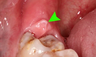 Không nhổ răng khôn vào những thời điểm sau để tránh các biến chứng về sau