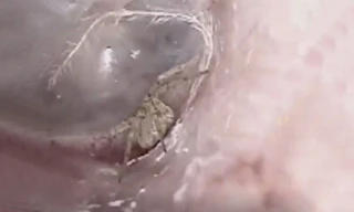 Nhện giăng tơ trong tai chàng trai trẻ