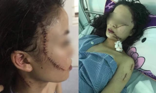 Toàn cảnh thiếu nữ 18 tuổi bị 3 cô gái đánh đập, rạch mặt giữa đêm
