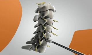 Cấy ghép đĩa đệm cổ nhân tạo tại Mỹ