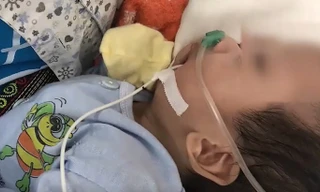 Căn bệnh nguy hiểm khiến trẻ có khuôn mặt hình mỏ chim