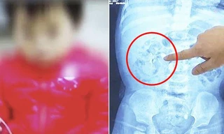 Bổ sung canxi quá liều, bé 9 tháng tuổi thận đầy sỏi