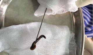Con đỉa dài gần 8cm sống trong khí quản bé trai