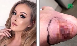 Đi dép quai hậu, nữ người mẫu suýt phải cắt chân