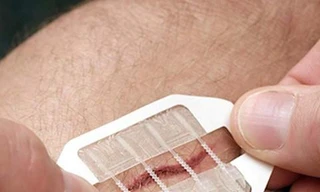 Miếng dán tiện lợi giúp khép vết thương hở mau hơn