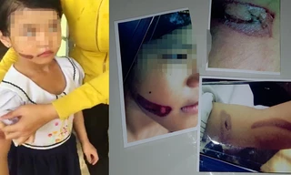 Vết thương ở tay và mặt bé T.