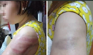 Nam Định: Giáo viên đánh học sinh tím người vì viết bài chậm