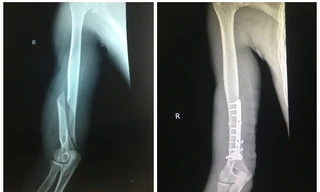 Chơi vật tay với bạn, thanh niên 19 tuổi bị gãy xương cánh tay