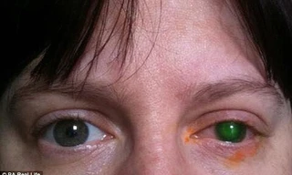 Mù mắt chỉ vì 20 phút đeo kính áp tròng xuống hồ bơi