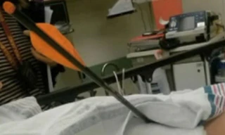 Chơi tại trường, bé 8 tuổi bị tên đâm thấu đùi