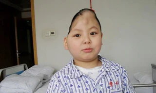 Phẫu thuật thành công cho cậu bé 'nửa đầu'