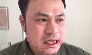 Nhân viên an ninh sân bay Nội Bài bị cò mồi taxi đánh gãy 4 răng