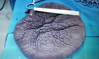 Khối bướu sau khi được lấy ra khỏi lưng “cô bé mai rùa” với đường kính hơn 22cm, nặng hơn 1kg. Ảnh do bệnh viện cung cấp.