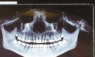 Ảnh chụp X-quang chiếc răng mọc ngược khiến Cao Fang bị đau hơn tháng qua.