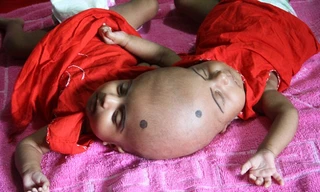 Cặp chị em song sinh dính liền đầu Rabia và Rukia.