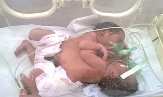 Cặp song sinh dính liền khi được điều trị tại Bệnh viện Việt Đức.