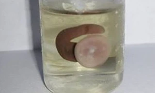 Con vắt dài 3 cm sống trong mũi chàng trai trẻ