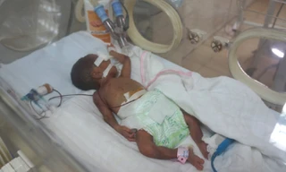 Bé gái được cấp cứu nhiều ngày trong lồng kính. Ảnh: Lê Hoàng/VnExpress