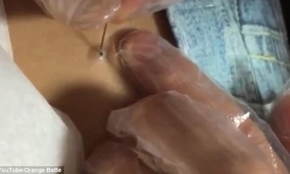 Kinh hoàng cảnh lôi một con sâu lớn từ nốt mụn ở lưng