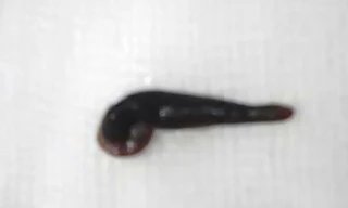  Con vắt "làm tổ" trong hốc mũi của trẻ 2 tuổi gần 10 ngày mới được gắp ra.