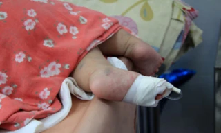 Hàng chục trẻ bị lây sởi ngay tại bệnh viện